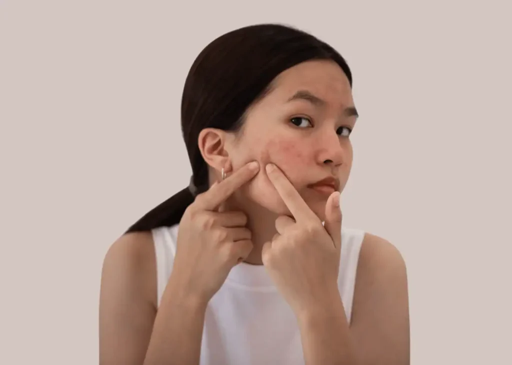 Best Korean Moisturisers For Acne-Prone Skin