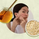 Easy Homemade Face Masks For Acne