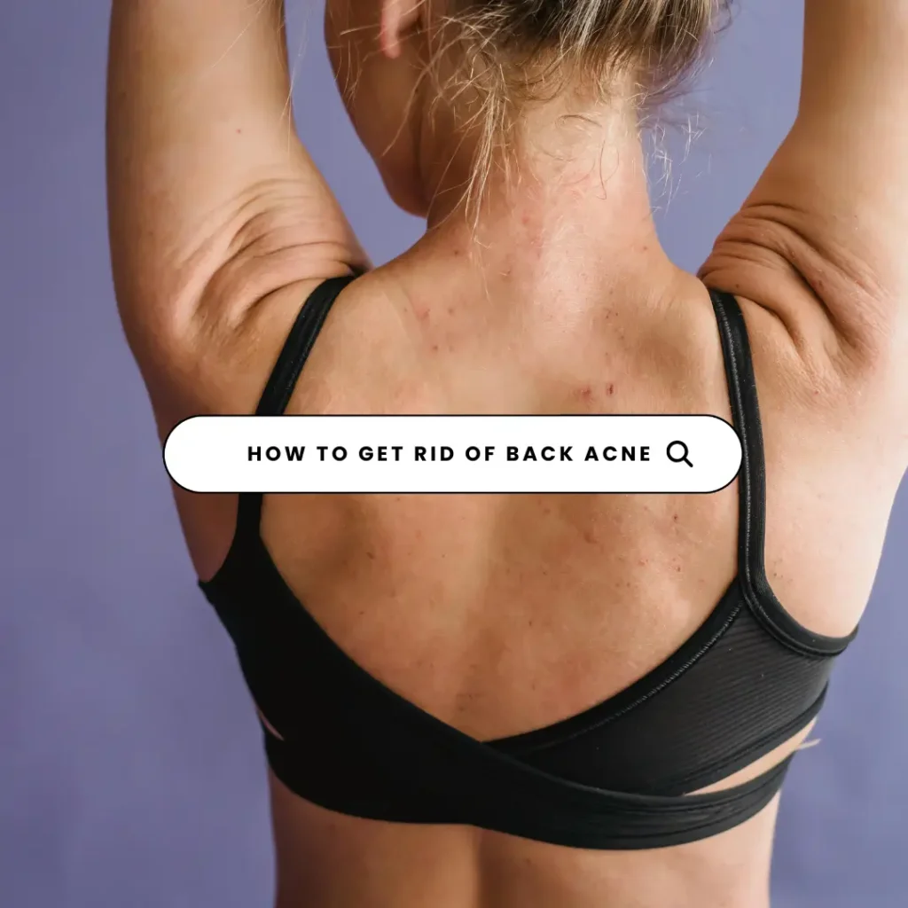 How To Get Rid of Back Acne