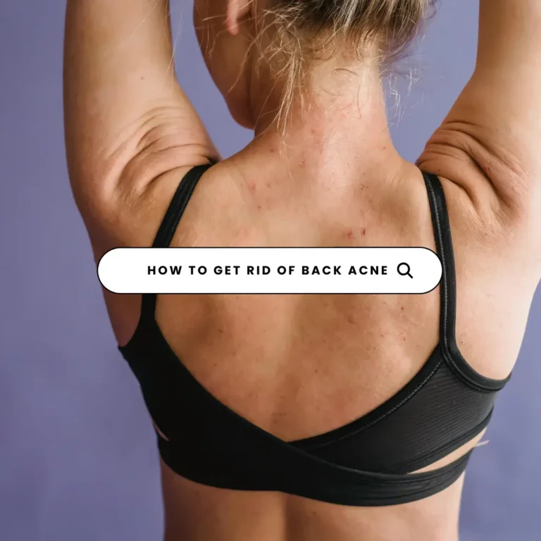 How To Get Rid of Back Acne